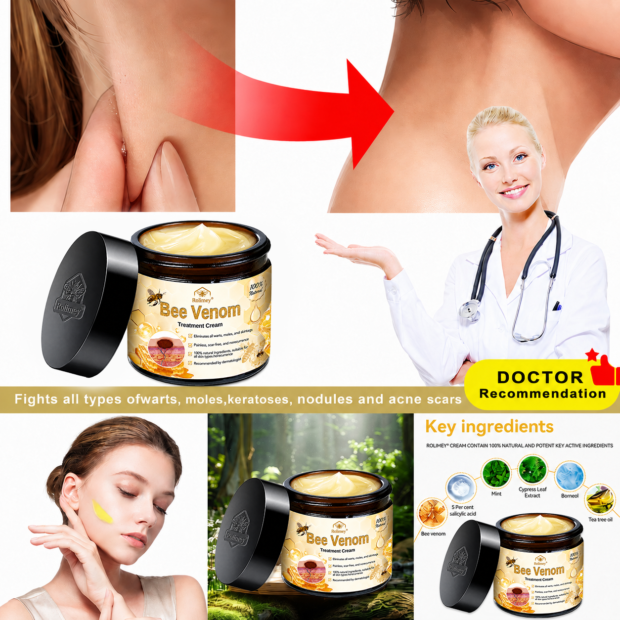 🔥Rolimey® Bee Venom Skin Treatment Cream - (Helping with acne, wart, rosacea, psoriasis, age spots, eczema, and reducing the appearance of stretch marks)