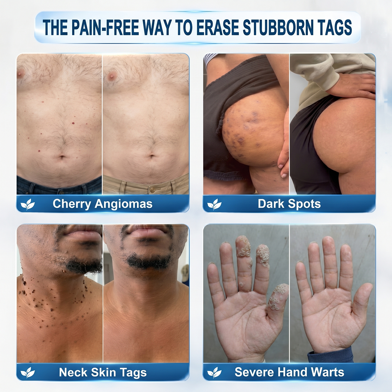 GFOUK® 🌿 𝐁𝐨𝐭𝐚𝐧𝐢𝐜𝐚𝐥 𝐌𝐢𝐜𝐫𝐨𝐧𝐞𝐞𝐝𝐥𝐞 𝐇𝐲𝐝𝐫𝐨𝐜𝐨𝐥𝐥𝐨𝐢𝐝 𝐏𝐚𝐭𝐜𝐡 (𝐅𝐨𝐫 𝐒𝐤𝐢𝐧 𝐓𝐚𝐠𝐬, 𝐒𝐦𝐚𝐥𝐥 𝐒𝐤𝐢𝐧 𝐆𝐫𝐨𝐰𝐭𝐡𝐬, 𝐖𝐚𝐫𝐭𝐬, 𝐌𝐨𝐥𝐞𝐬, 𝐀𝐠𝐞 𝐒𝐩𝐨𝐭𝐬 & 𝐏𝐢𝐠𝐦𝐞𝐧𝐭𝐚𝐭𝐢𝐨𝐧 𝐂𝐨𝐧𝐜𝐞𝐫𝐧𝐬)