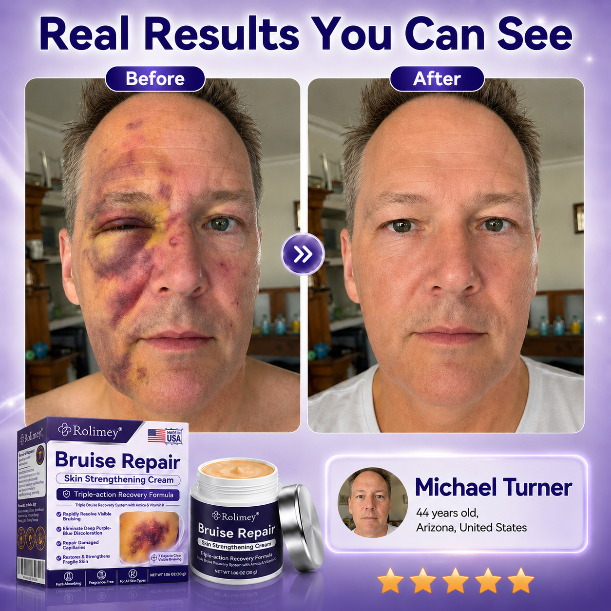 Rolimey® cream to repair bruises and strengthen the skin