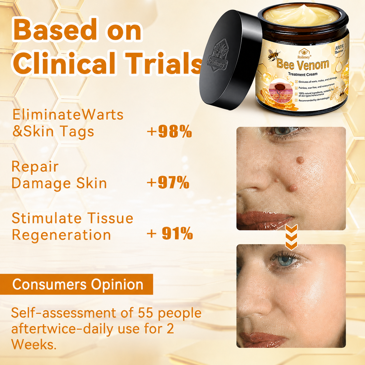 🔥Rolimey® Bee Venom Skin Treatment Cream - (Helping with acne, wart, rosacea, psoriasis, age spots, eczema, and reducing the appearance of stretch marks)