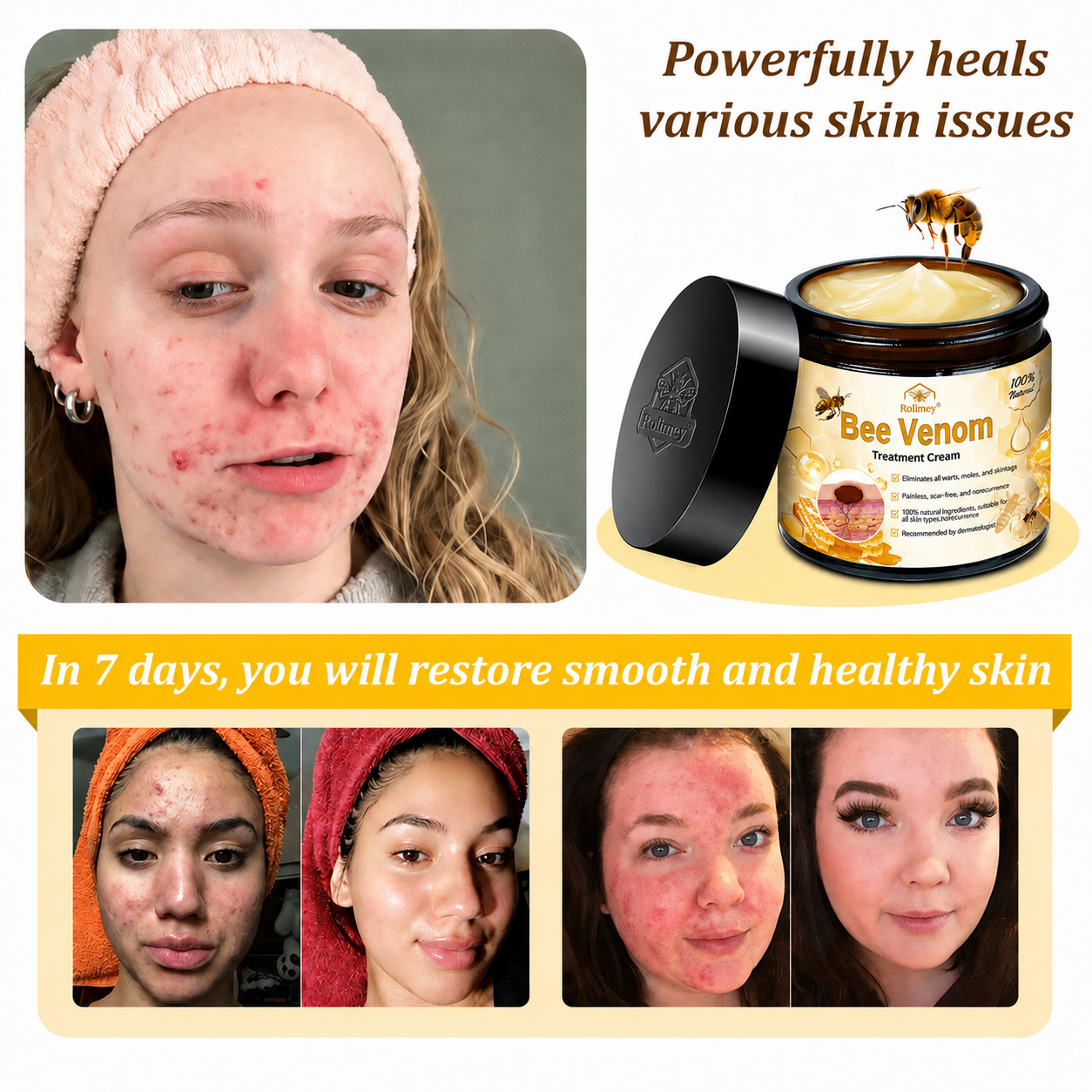 Rolimey® Bee Venom Skin Treatment Cream🔥🔥