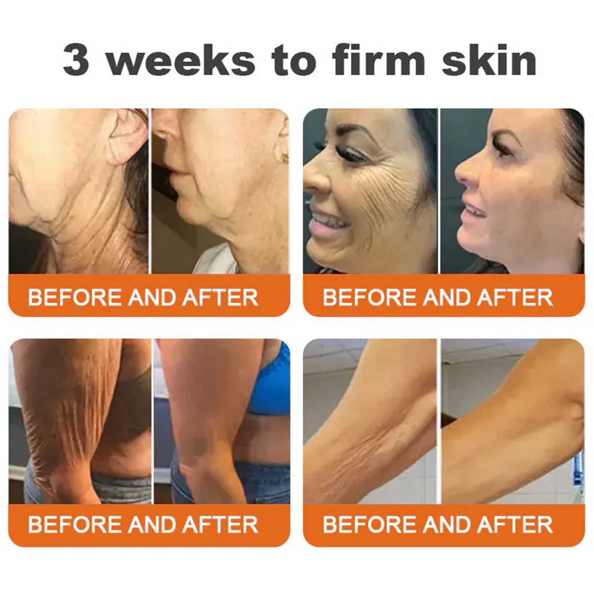 ✅✅Rolimey® Bee Venom Skin Treatment Cream - (Helping with acne, rosacea, psoriasis, age spots, eczema, and reducing the appearance of stretch marks)
