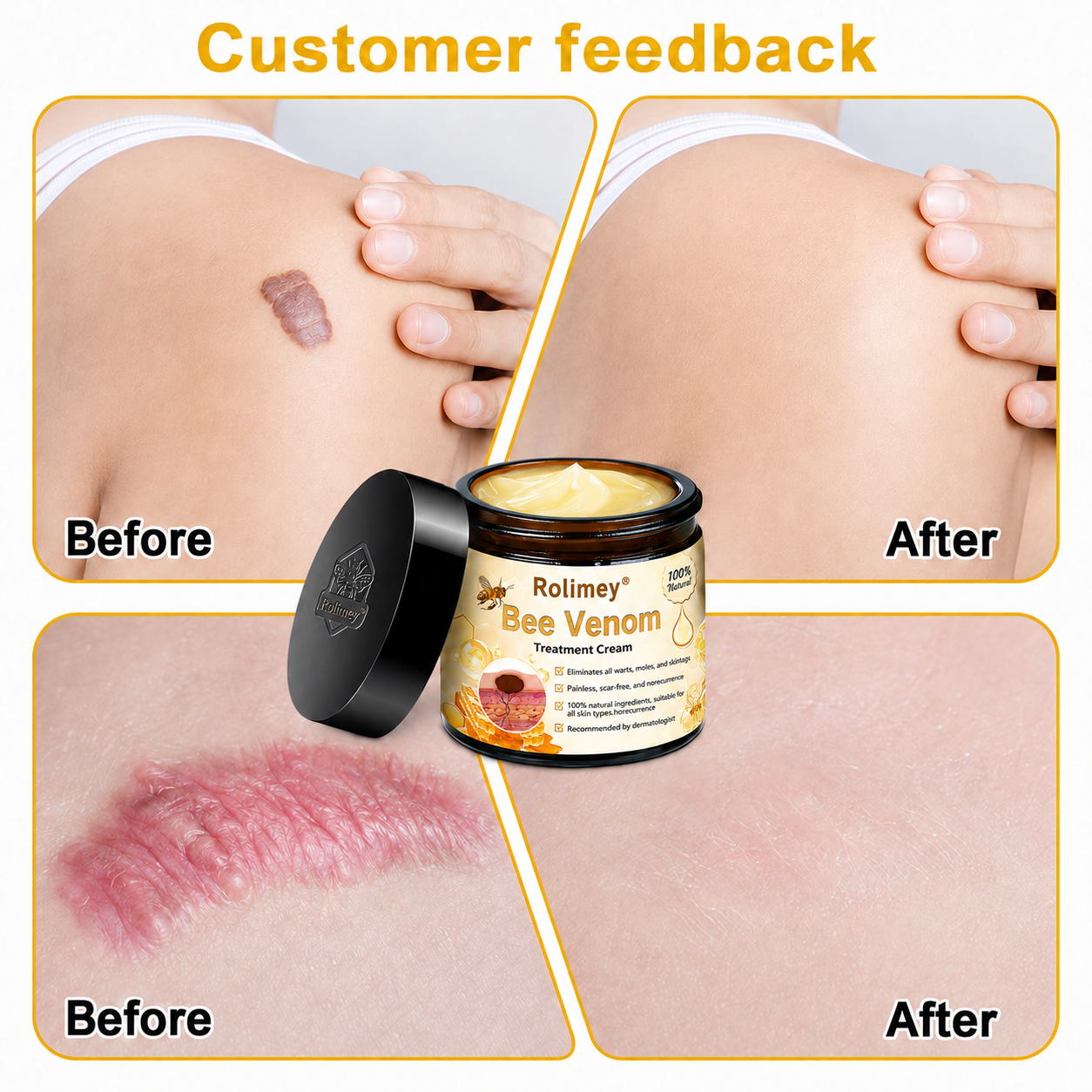 🔥Rolimey® Bee Venom Skin Treatment Cream - (Helping with acne, wart, rosacea, psoriasis, age spots, eczema, and reducing the appearance of stretch marks)