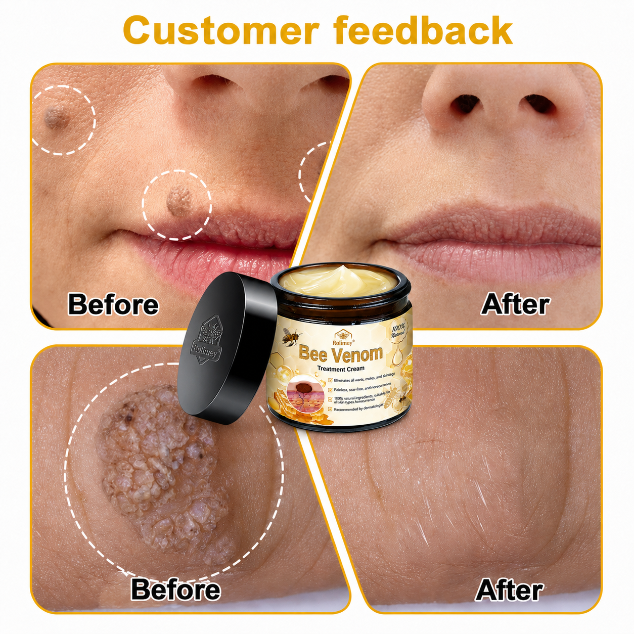 🔥Rolimey® Bee Venom Skin Treatment Cream - (Helping with acne, wart, rosacea, psoriasis, age spots, eczema, and reducing the appearance of stretch marks)